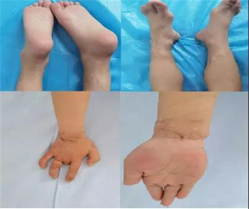 先天性束带综合症(congenital constricting band syndrome,ccbs)为